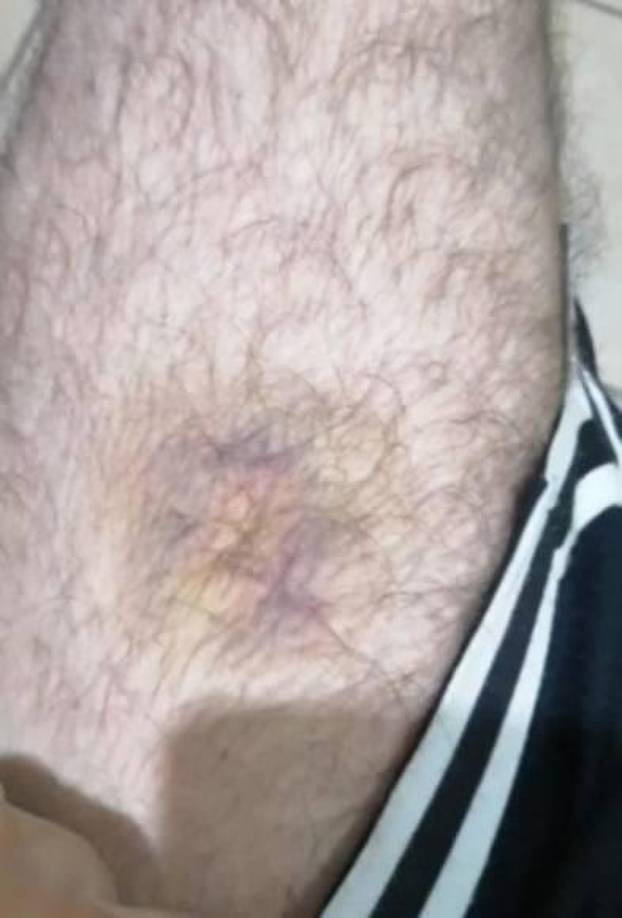 A través de un video, Gilbert Reyes mostró las marcas que la golpiza habría dejado en su cuerpo, evidenciando moretones en sus pantorrillas y espalda.