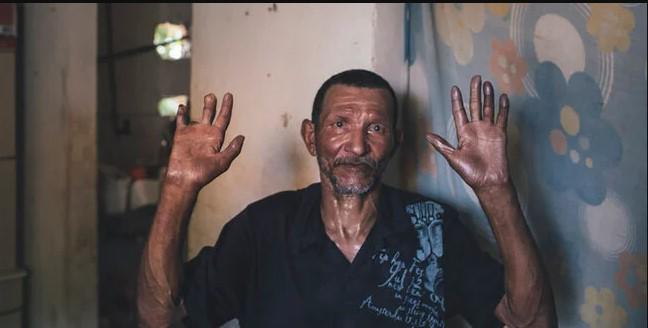 Alarma por detección de 16 casos de lepra en Choluteca