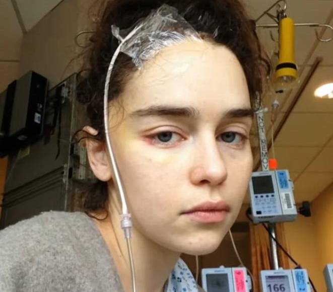 Emilia sufrió dos aneurismas en 2011 y 2013 y compartió su historia por primera vez en un ensayo de 2019 para The New Yorker publicado poco antes del estreno de la última temporada de Game of Thrones.