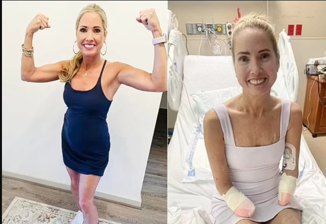 La sepsis es una complicación crítica que puede surgir de diferentes tipos de infecciones, incluyendo aquellas en los pulmones, el tracto urinario, la piel o el tracto gastrointestinal. A menudo, sus síntomas se asemejan a los de la gripe, lo que dificulta su diagnóstico temprano. Aunque no hay una prueba única para detectar la sepsis, los médicos se basan en signos de infección y análisis de sangre para su diagnóstico.