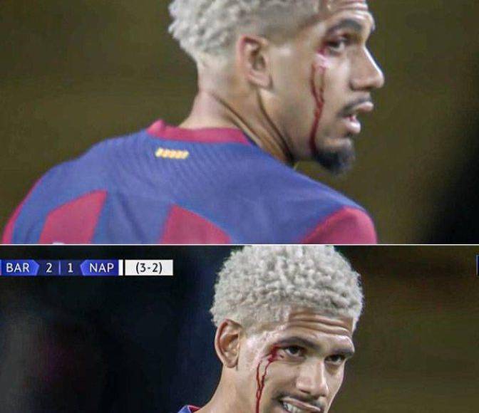 Así fue el corte que sufrió Ronald Araújo, defensa del Barcelona, quien tuvo un gran partido ante los italianos en los cuartos de final de la Champions.