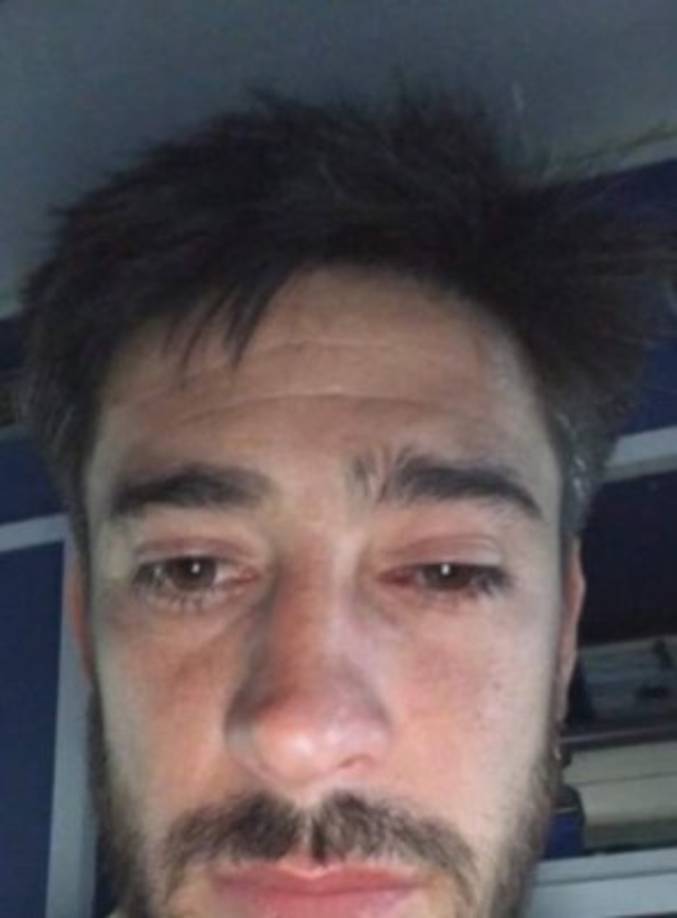 El capitán Pablo Pérez fue uno de los afectados y así le quedó uno de sus ojos.