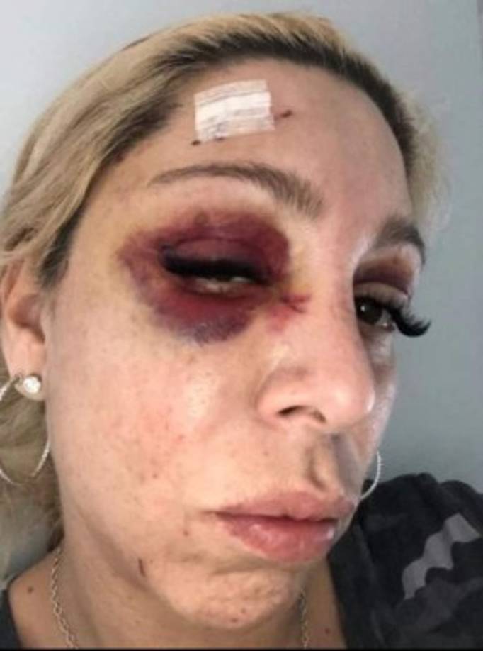 La actriz dijo que comenzaría a trabajar en la producción televisiva 'Brooklyn Ties', algo que ahora se ve en peligro debido a su rostro.