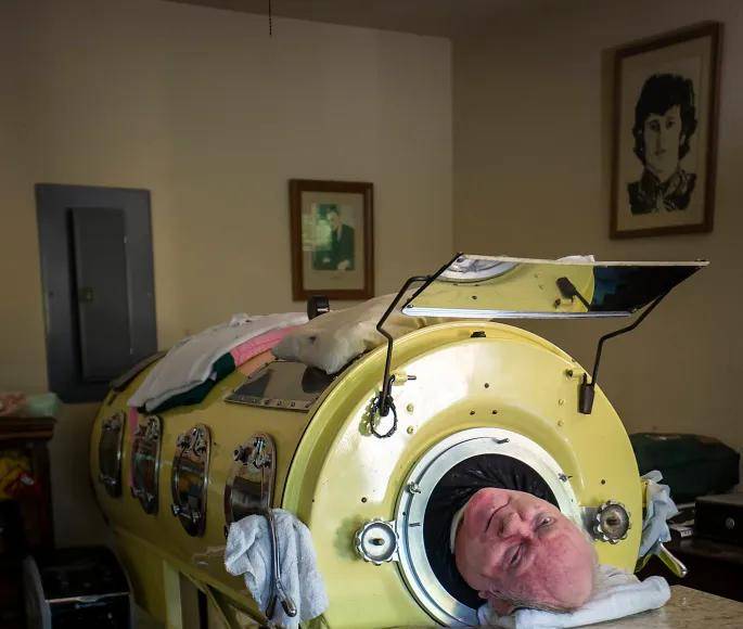 La respuesta médica a su condición fue colocarlo en un pulmón artificial, una máquina que lo mantuvo con vida durante más de 70 años. A pesar de su discapacidad, Alexander logró superar las adversidades, obteniendo una licenciatura en Derecho en 1984 por la Universidad de Texas en Austin.