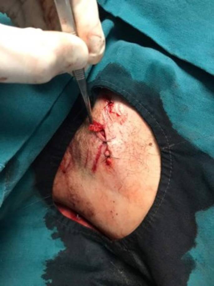 Además de compartir un “live” para contar su experiencia, Tavo Vallecillo publicó algunas fotos para mostrar cómo quedaron varias partes de su cuerpo tras ser mordido por el can.