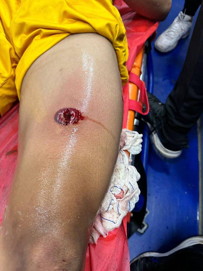 El impacto quedó registrado y su pierna quedó así.