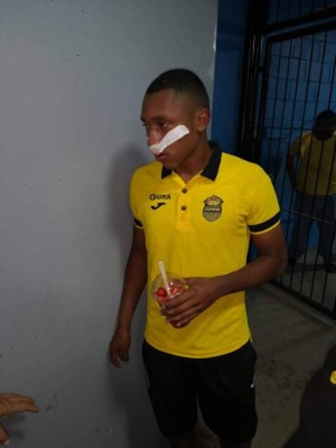 El joven Miguel Carrasco del Real España fue llevado de emergencia a un centro asistencial por hemorragia nasal. Sufrió una patada de Jeancarlo Vargas en la nariz y no pudo continuar jugando el encuentro <br/>