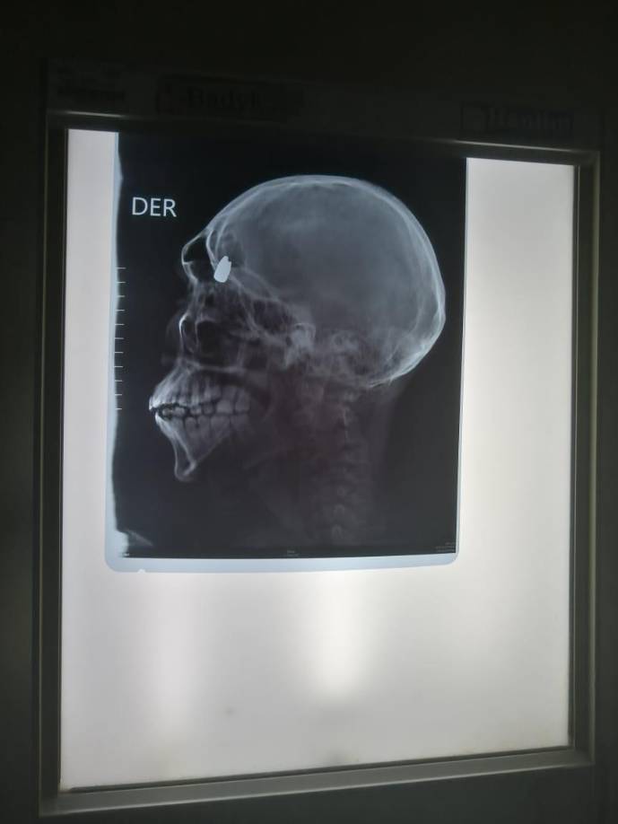 En el fatal incidente también resultó herido el hermano de la víctima, identificado como Brayan David Ebanks (de 14 años). 