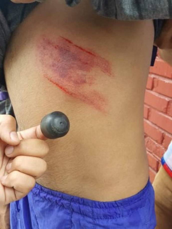 En las redes sociales uno de los manifestantes divulgó una imagen en donde aseguró haber recibido un golpe con una bala de goma.