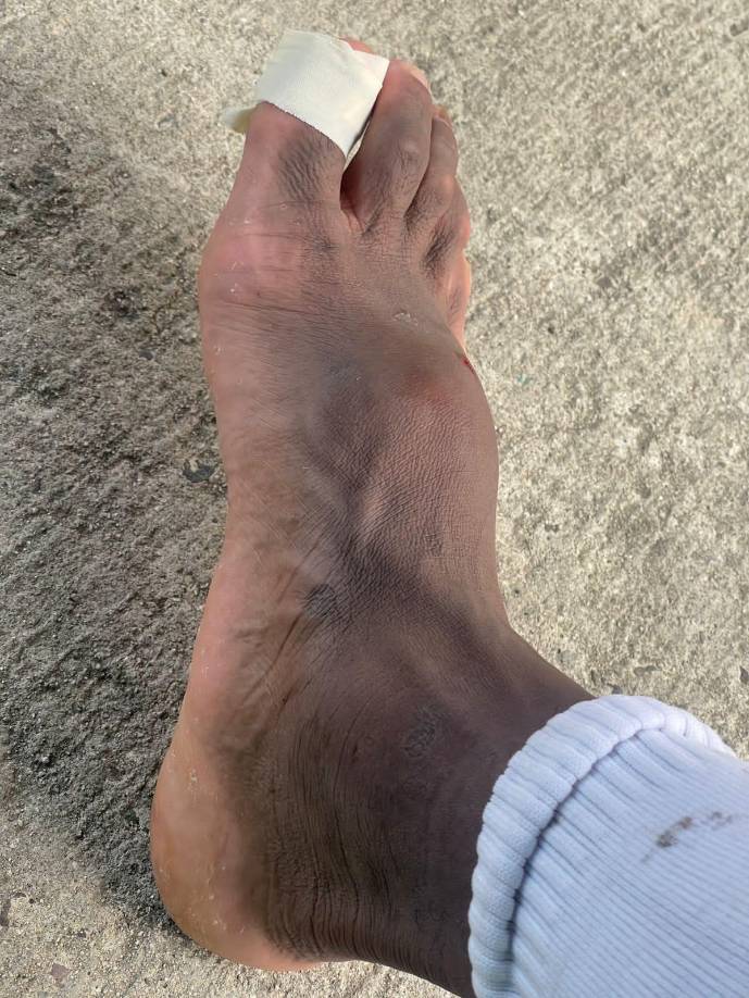 Así de inflamado le quedó el pie al delantero hondureño Clayvin Zúniga.