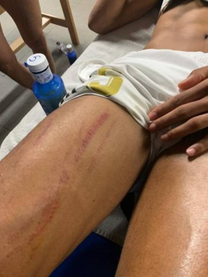 Así de lastimada quedó la pierna derecha de Raphael Varane tras el patadón de Clément Lenglet.