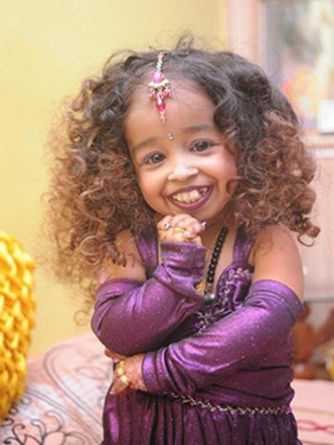 Jyoti Amge debe su extraña condición a la acondroplasia, una causa común de enanismo que modifica el ADN y causa alteraciones en el crecimiento.<br/>La acondroplasia se presenta en una de cada 25 mil personas vivas.