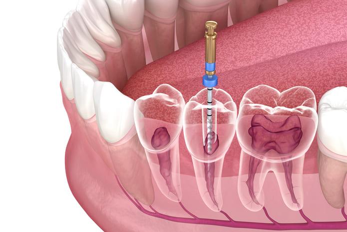 La endodoncia es un proceso en el que se realiza la extirpación total o parcial de la pulpa dental afectada.