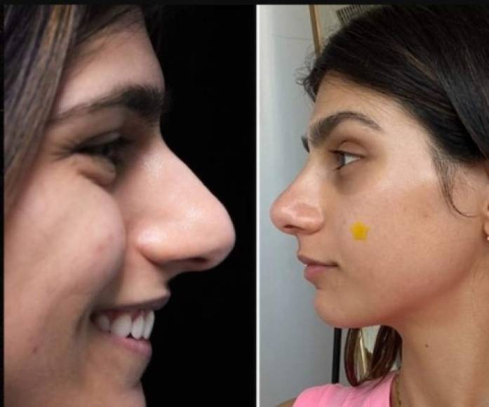 El portal TMZ compartió una foto que presuntamente muestra el antes y después de la rinoplastia de Mia Khalifa, aunque ella no ha compartida su nuevo aspecto en sus redes oficiales.