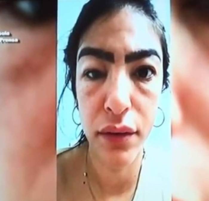 Lejos de mejorar su rostro, a la actriz mexicana le dejaron la cara marcada de por vida.