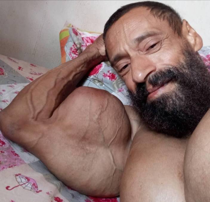 El synthol es el resultado peligroso de la mezcla de aceite, lidocaína y alcohol bencílico, la cual permite un aumento inmediato del volumen debido a que funciona como un implante sobre el cuerpo. El uso de esa sustancia aumenta el riesgo de infecciones, fibrosis muscular, tumores, problemas cerebrales y musculares.