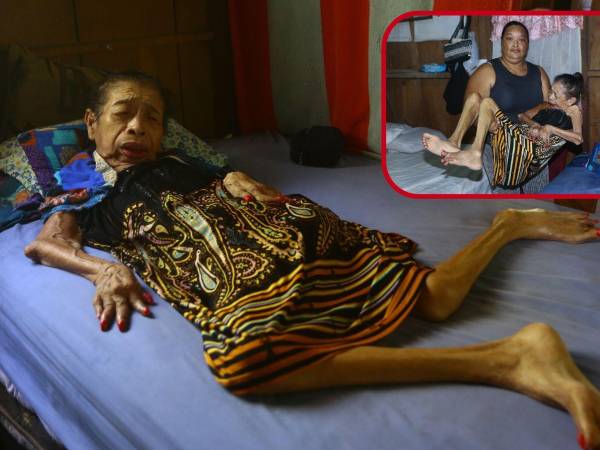 Casi el 100% de las extremidades de su cuerpo están paralizadas debido a una aparente artritis reumatoide que la afecta con dolores desde que tenía 20 años de edad.