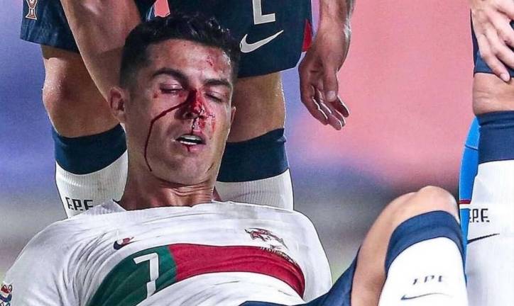El fuerte golpe que dejó a Cristiano Ronaldo con el rostro ensangrentado