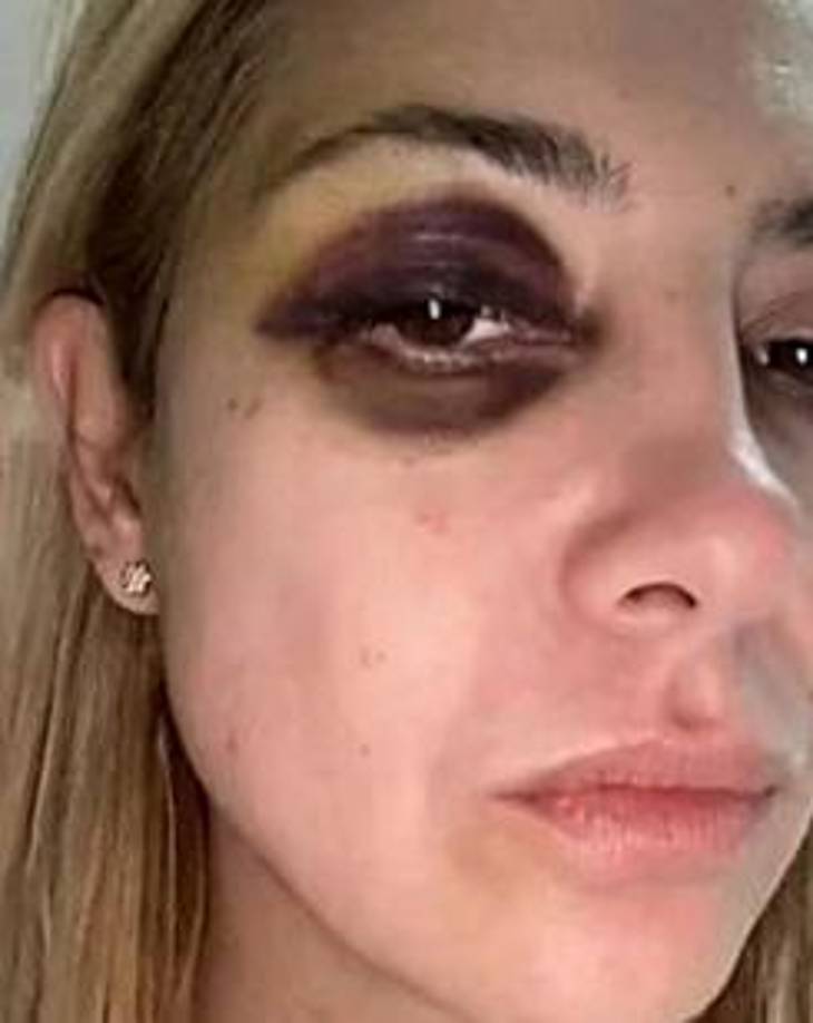 En una de las imágenes, que, según el medio, estarían tomadas en agosto de 2021, en plena pandemia de covid-19, Yáñez muestra un moratón en la cara interior del brazo, y en otra un cerco negro alrededor del ojo derecho.