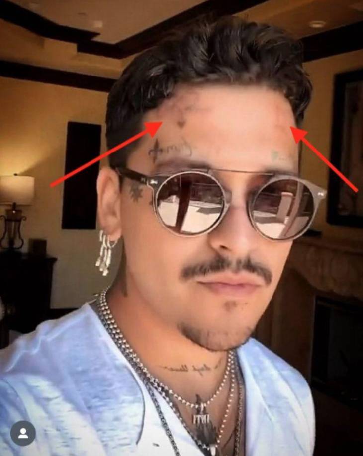 Actualmente Nodal ha decidido que ya es tiempo de limpiar su rostro y que su hija lo conozca sin tatuajes, por lo que deberá quitar entre 15 y 17 de estos para que su frente, mejillas, y la zona T de su cara queden totalmente libre de tinta. 