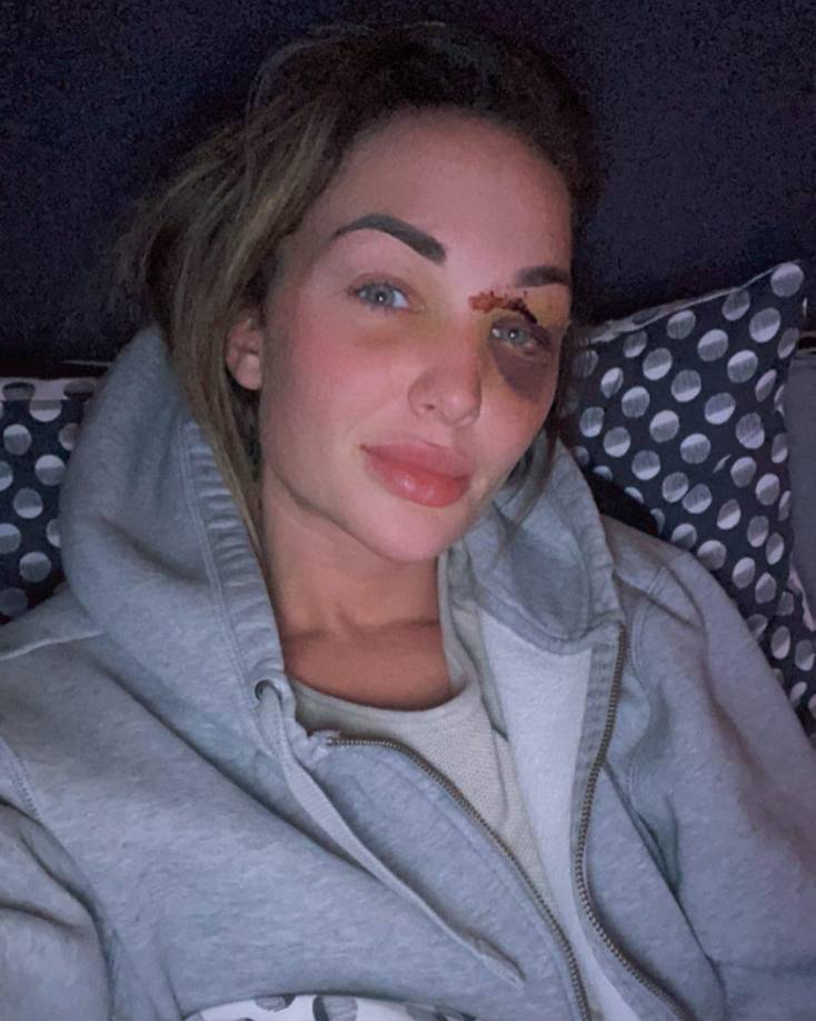 El sábado 11 de febrero, Chayenne debía entregar su corona de Miss Bélgica a la nueva representante, pero por su accidente no pudo asistir al evento. Por tal motivo, el domingo subió esta selfie en Instagram con el siguiente mensaje: “Al final de un año, pero no el final de todo lo que quiero representar. No ha sido fácil este año, pero me ha enseñado muchas cosas que quiero compartir con ustedes y defender.Quiero agradecer a todos los que me han apoyado desde el principio y todavía están conmigo. @missbelgiumTodos los hermosos recuerdos y experiencias permanecerán en mi corazón para siempre.Después de este trágico accidente veo más a la persona detrás del título, que perdí por un tiempo. Lástima que no pude estar allí anoche. Pero el universo a menudo decide las cosas por nosotros.”