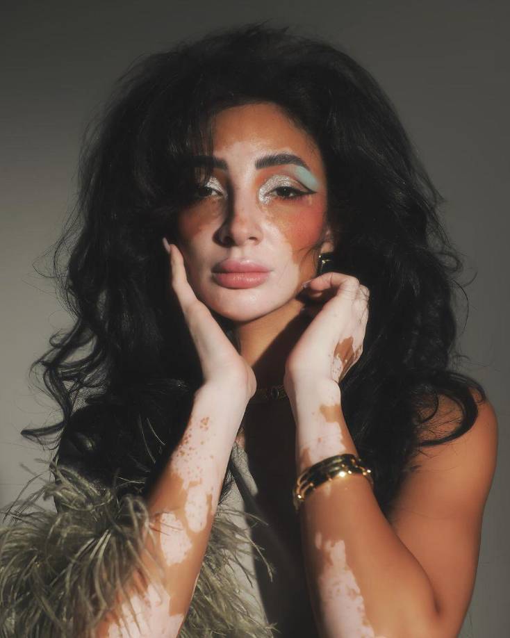 La ahora reina de belleza reveló que diagnosticaron lupus a la edad de 8 años, lo que le causó psoriasis y vitiligo, por lo que sufrió bullying (acoso escolar) durante su infancia y adolescencia. 