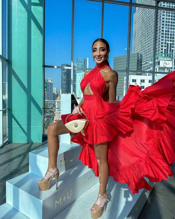 Logina predica un mensaje de empoderamiento y aceptación, pues ha dicho que venció sus inseguridades gracias a un arduo esfuerzo propio y el apoyo de su familia. Sus manchas son más visibles en el rostro, las manos y los pies pero su actitud es el mejor ejemplo de amor propio, seguridad e inteligencia. 