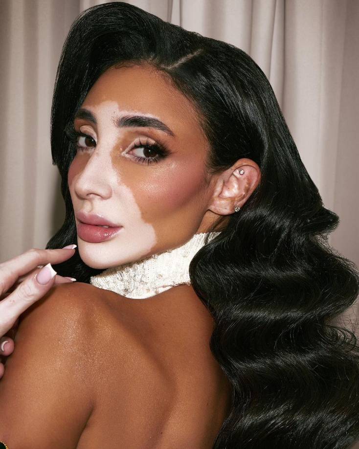 El vitiligo es una enfermedad autoinmune que se caracteriza por la destrucción de las células que producen la melanina, el pigmento de color café de la piel. Se manifiesta como manchas blancas de distintos tamaños en diferentes partes del cuerpo, llamadas máculas. 