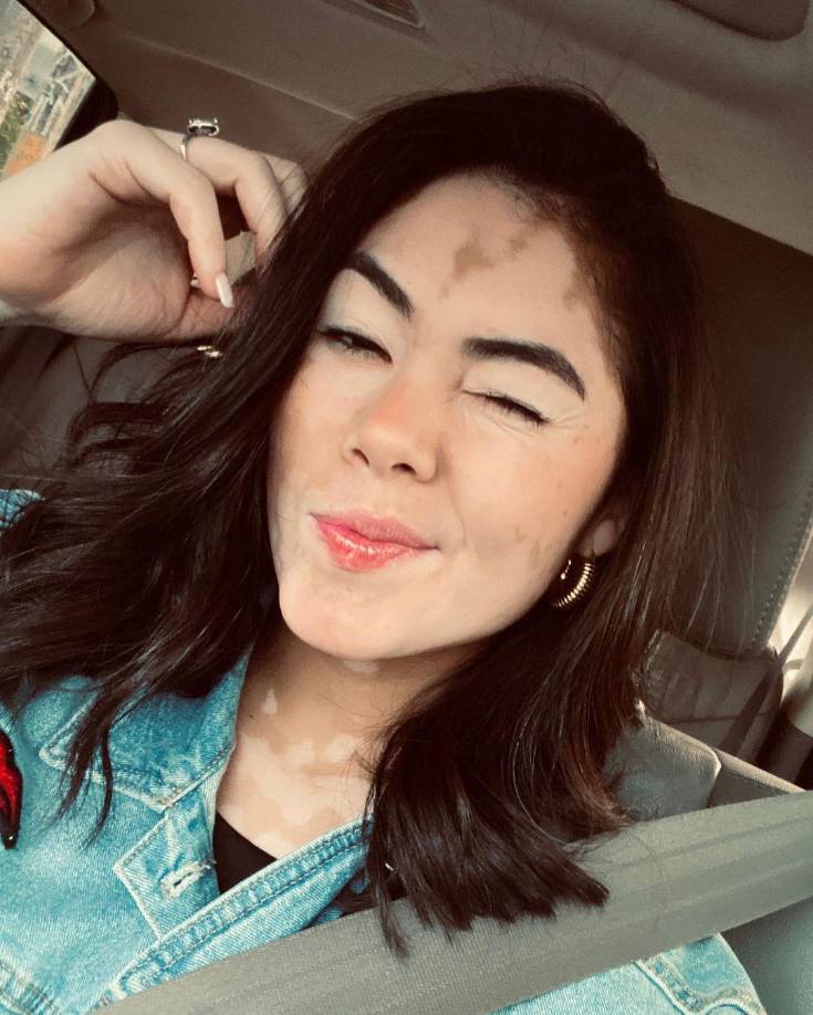 Para Enamorado la etapa más complicada fue la escuela debido al bullying. Padece esta condición de la piel desde los 6 años de edad, pero conforme fue creciendo fue aceptando el proceso de vida y ahora dio ese paso importante que la convierte en una vocera de la mujer segura de sí misma y con belleza real por mostrar. 