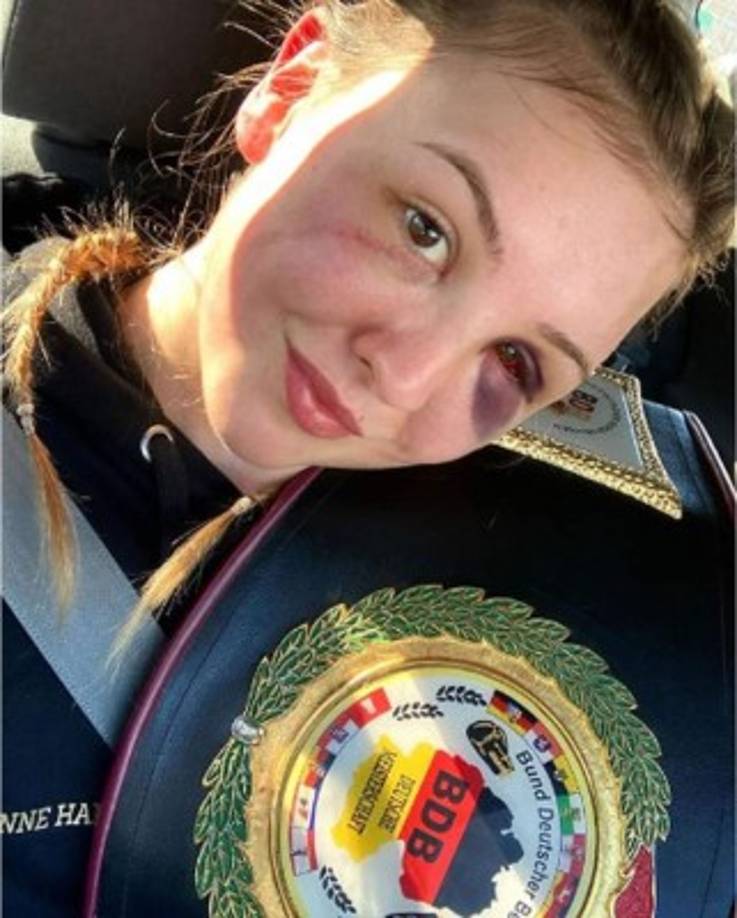 El rostro de 'Pepper' Hanson quedó visiblemente lastimado luego del combate frente a la ucraniana Aline Zaitseva que se definió en las tarjetas y la alemana se llevó el triunfo por decisión técnica.