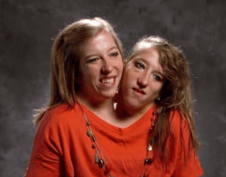 Abby, una de las gemelas siamesas más conocidas del mundo, junto a su inseparable hermana Brittany, ha dado un paso significativo en su vida personal al contraer matrimonio con Josh Bowling, un veterano de guerra y enfermero.