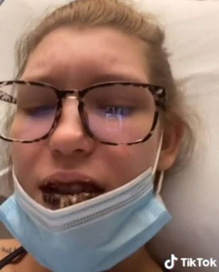 Se trata de una infección fúngica grave y es bastante rara. De acuerdo con algunos informes afecta a las personas con problemas de salud o quienes toman medicamentos que afectan al sistema inmune.