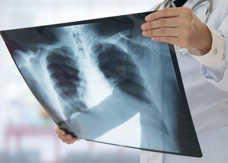 La tuberculosis vuelve a propagarse en el mundo, advierte la OMS