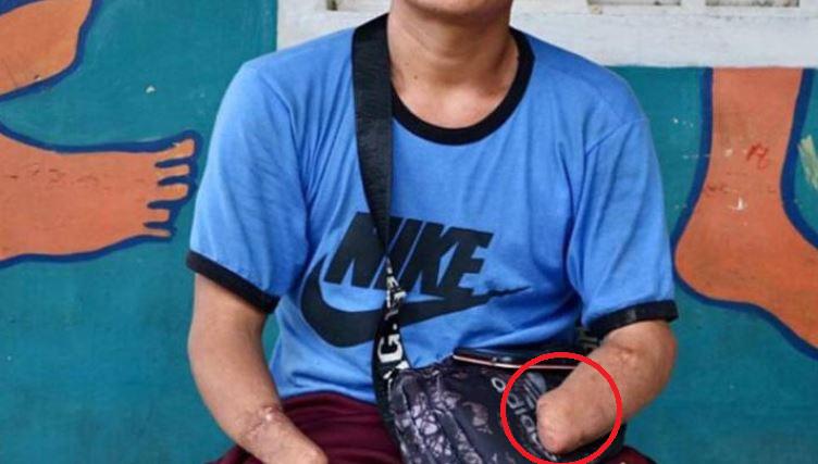 Desgarrador relato de hondureño al que pandillero le cortó los brazos por no pagar extorsión