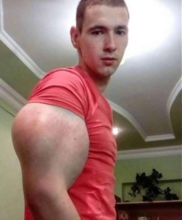 El sueño del ruso Kirill Tereshi era ser la persona con los brazos más grandes del mundo.