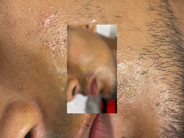 La herida en la parte superior del labio de Alejandro Raudales. El volante también tuvo que ser intervenido para cubrir y sanar la herida.