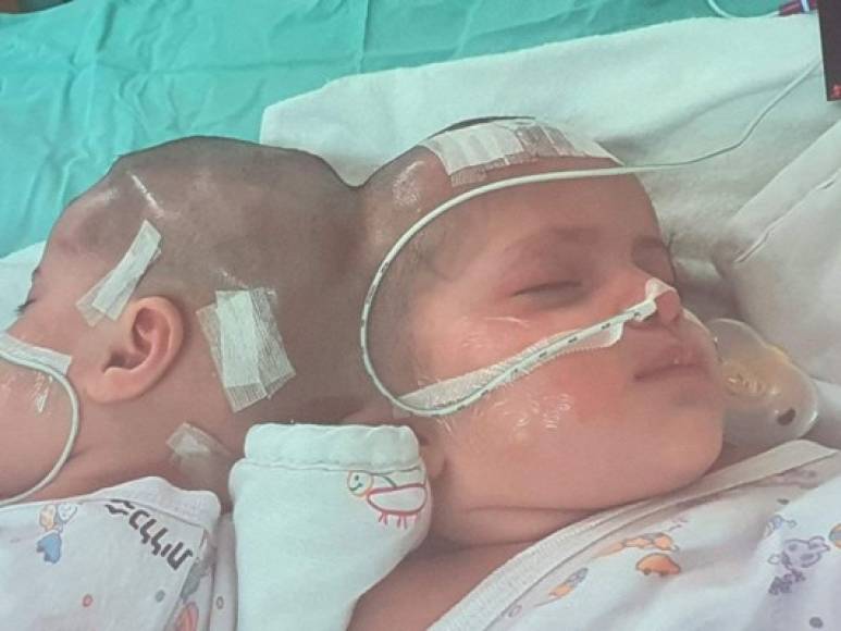 La intervención quirúrgica duró 12 horas en un centro médico de Beer Sheva. Fue la primera intervención para separar a gemelos siameses en Israel.