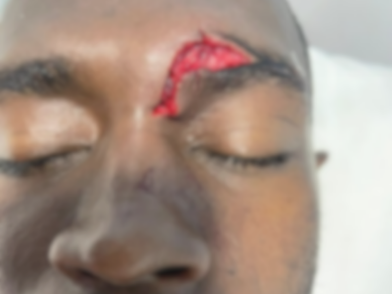 La imagen sobre el corte de ceja es espeluznante, al futbolista le tuvieron que suturar con siete puntos.