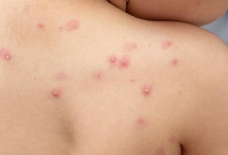 Existe una vacuna contra variante de la viruela del mono