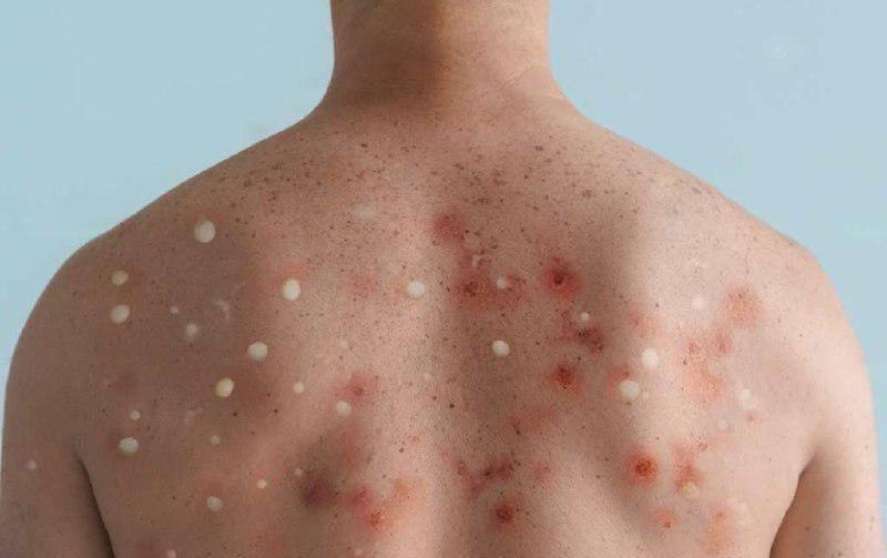 Salud confirma un nuevo caso de viruela del mono en Honduras