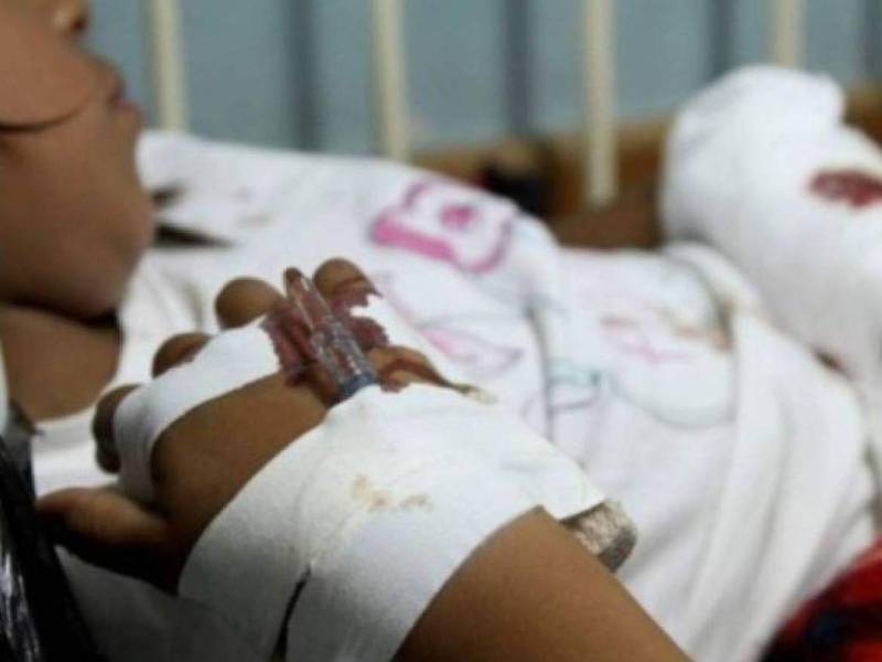 133 niños quemados han sido atendidos por la Cehniq en lo que va del año