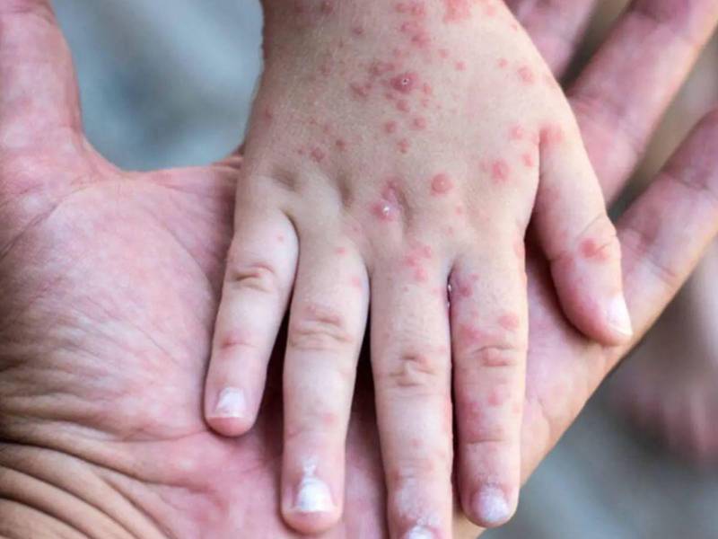 Este nuevo caso está relacionado con los contagios dados a conocer durante el fin de semana, ya que la menor es <b>compañera de escuela </b>de uno de los niños previamente diagnosticados.