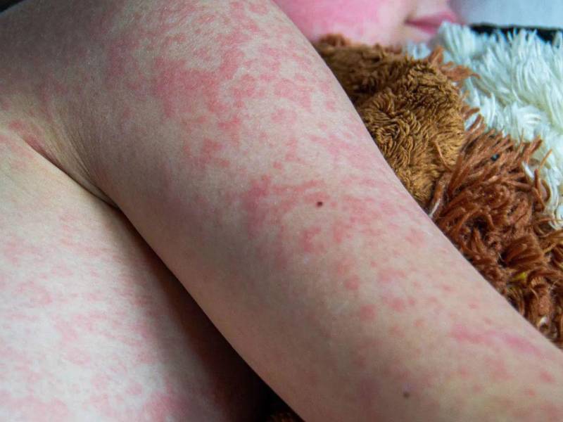 Hasta el momento, Guatemala registra 3.594 casos de sarampión a nivel nacional.