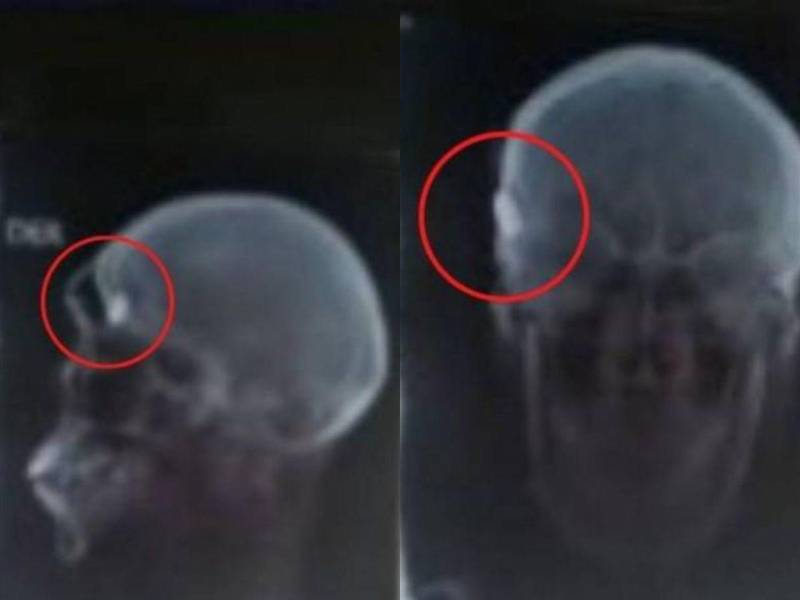 Radiografía hecha al menor Brayan David Ebanks.