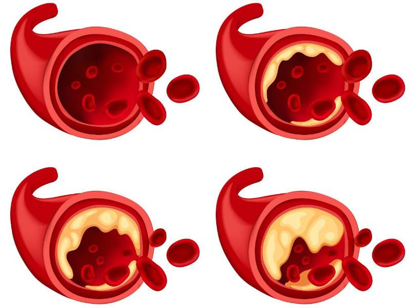 La placa de ateroma se va acumulando progresivamente en el interior de las arterias.