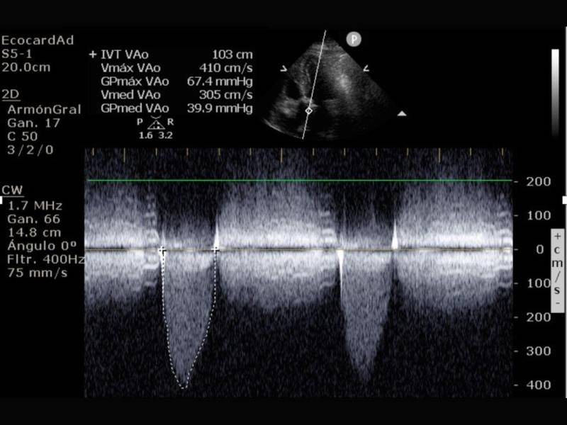 El ecocardiograma confirmó la presencia de estenosis aórtica severa, paso fundamental para el diagnóstico y la planificación del tratamiento.