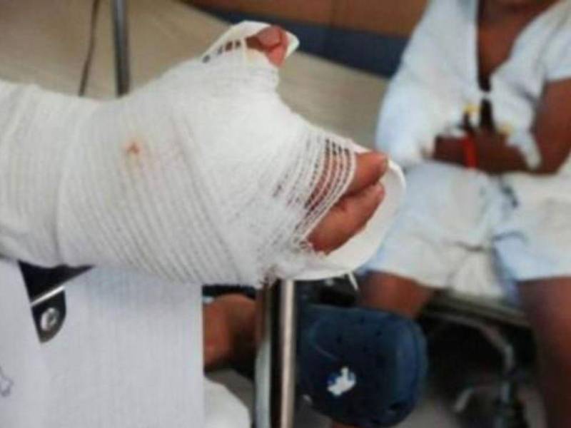 Uno de los menores ingresados la noche del miércoles 27 de diciembre fue afectado por un mortero que le causó daños en su mano derecha.