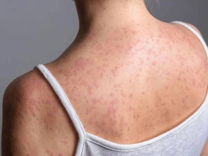 Salud llama a niños, adolescentes y adultos susceptibles a completar su esquema de vacunación para prevenir el sarampión.