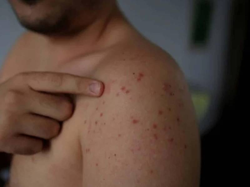 Autoridades sanitarias mantienen vigilancia epidemiológica intensificada ante la alerta regional, tras la confirmación de nuevos casos importados en el país.