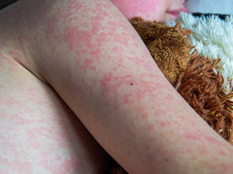 Expertos en salud pública exhortan a la población hondureña a reforzar las medidas de prevención.